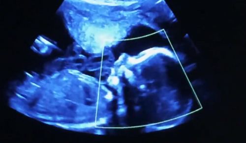 Florida AG Tells State Supreme Court: There's No Right to Kill Babies in Abortions