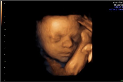 New York Times Said Abortion Debate Was Over in 1973, We're Still Fighting for Unborn Babies